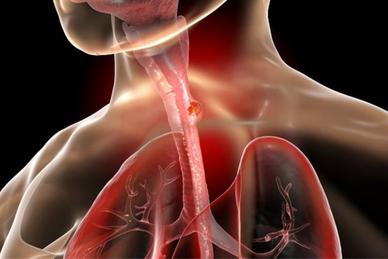 Esophageal Stenting